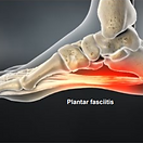 plantar-fasciitis