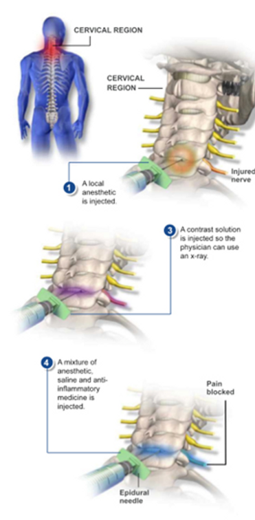 cervical-epidural-steroid-injection