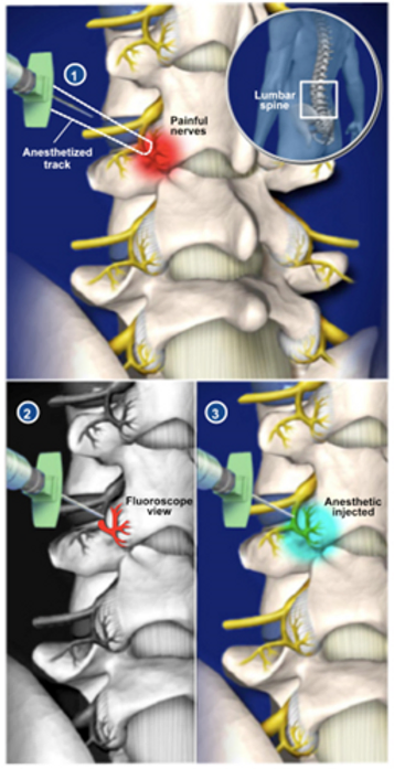 medial-branch-block