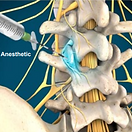 medial-branch-block