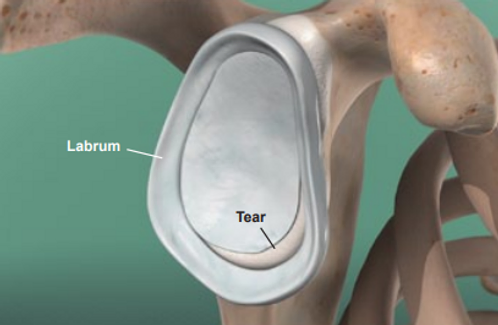 glenoid-labrum-tear-symptoms