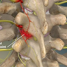 radiofreq-neurotomy-thoracic-facets