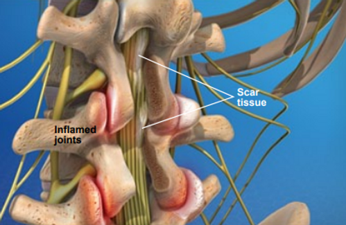 symptoms-of-post-laminectomy-syndrome