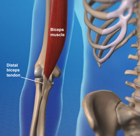 biceps-tendonitis