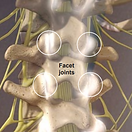 facet-joint-sydrome