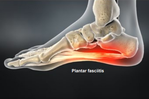 symptoms-of-plantar-fasciitis