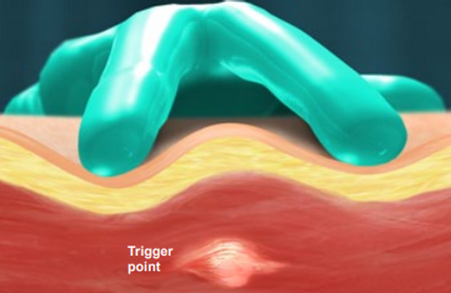 trigger-point-injection