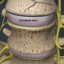 degenerative-disc-disease