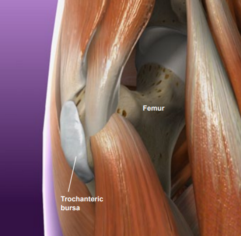 Hip Bursitis: Cause, Symptoms, Exercises & Treatment, Texas