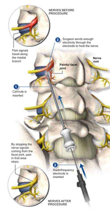 lumbar-radiofrequency-neurotomy