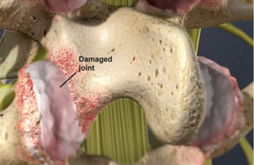 damaged-joint