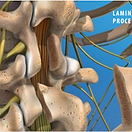 post-laminectomy-syndrome