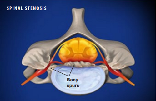 spinal-stenosis