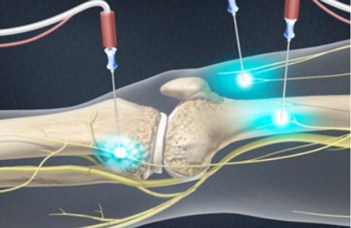 genicular-nerve