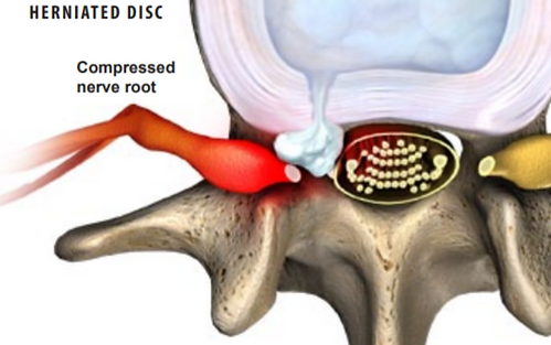 herniated-disc