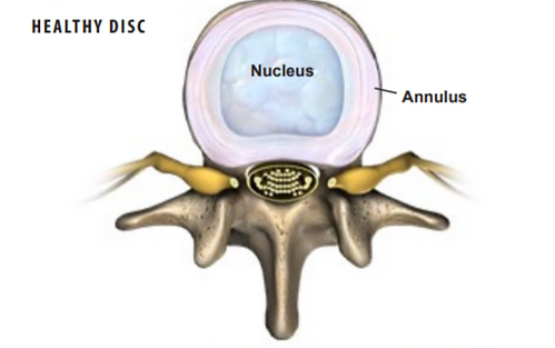 herniated-disc