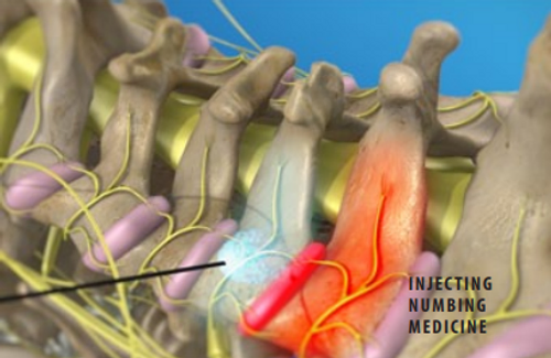 injecting-numbing-medicine