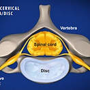 cervical-facet-radiofreq-neurotomy