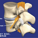 spondylosis
