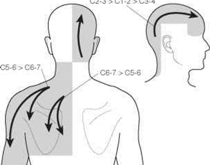 cervicogenic-headaches