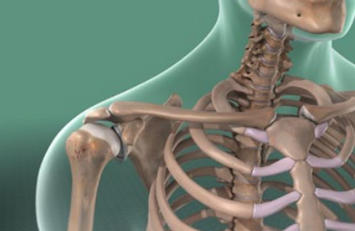 glenoid-labrum-tear