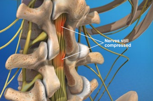 causes-of-post-laminectomy-syndrome