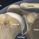 osteoarthritis-of-the-shoulder
