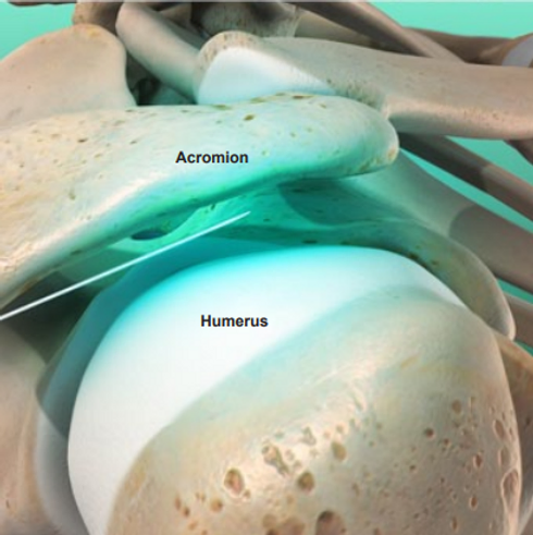 subacromial-injection