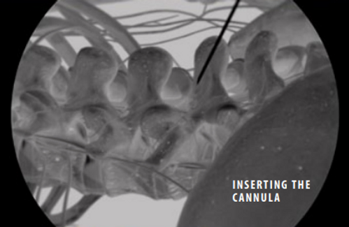 inserting-the-cannula