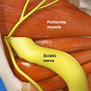 piriformis-syndrome