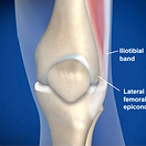 iliotibial-band-syndrome