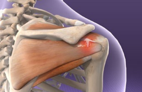 rotator-cuff-injuries