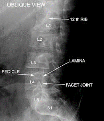 athritis