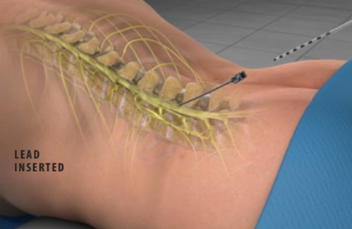 spinal-cord-stimulator-implant