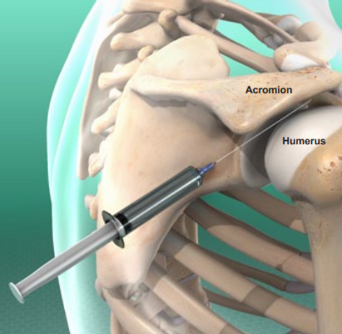 subacromial-injection