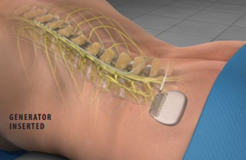 spinal-cord-stimulator-implant