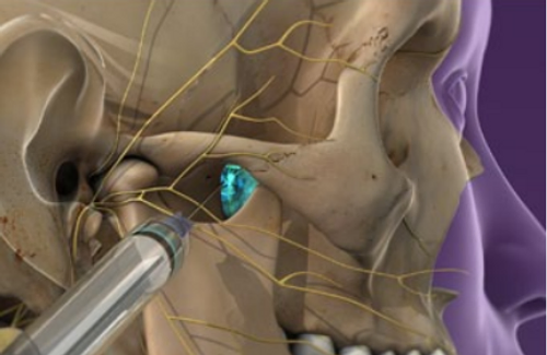 sphenopalatine-ganglion-block