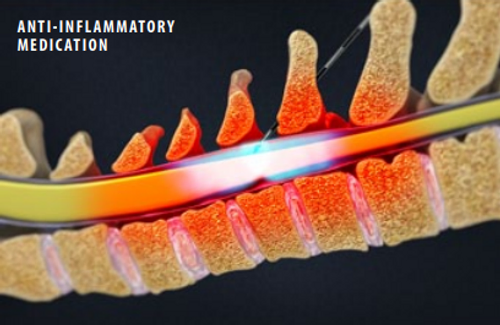 anti-Inflammatory-medication