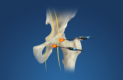 joint-radiofrequency-neurotomy