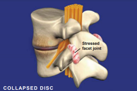 spondylosis