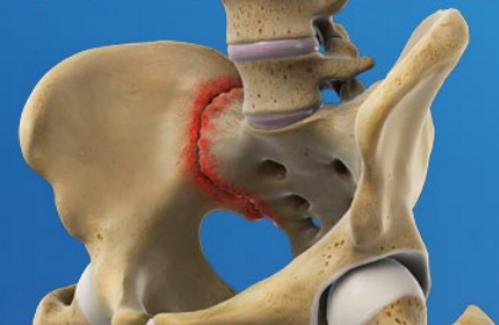 causes-of-sacroiliac-joint-pain