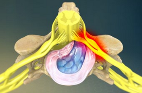 herniation