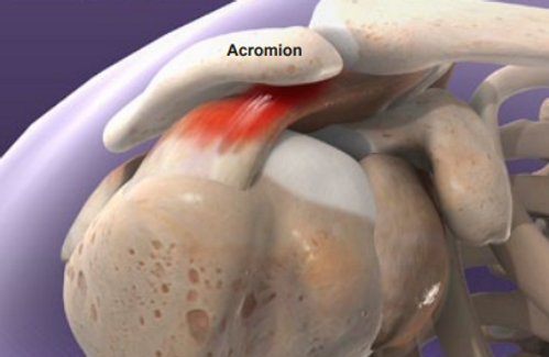 symptoms-of-shoulder-impingement-syndrome