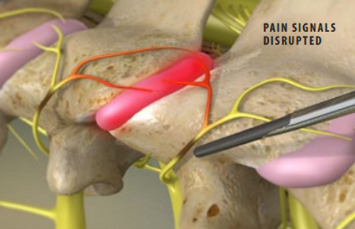 pain-signals-disrupted