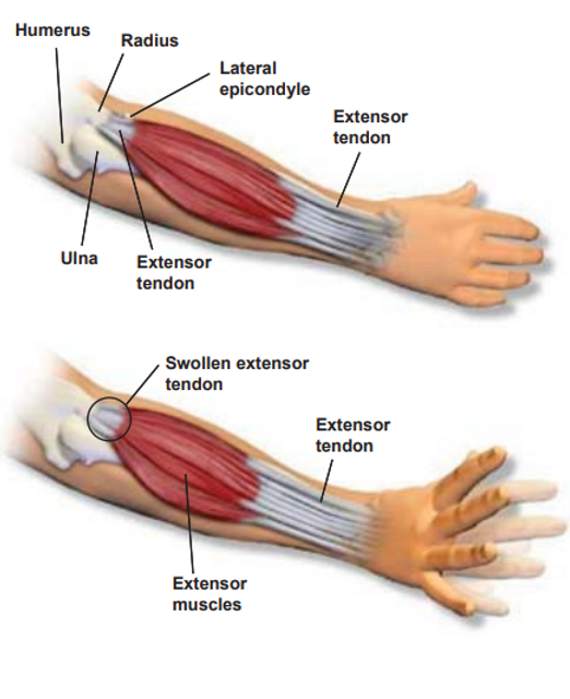 lateral-epicondylitis