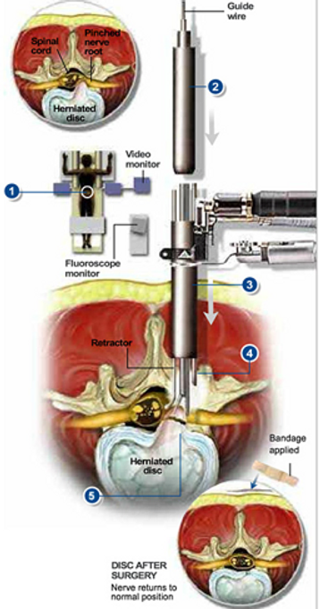 minimally-invasive