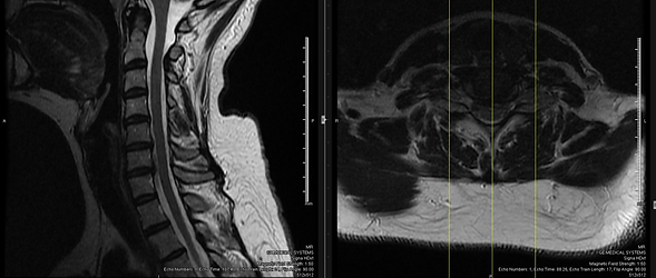 Chiropractic management of post spinal cord stimulator spine pain