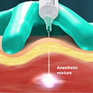 trigger-point-injections