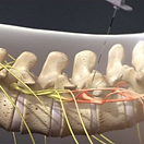 lumbar-transforaminal-epidural-steroid