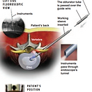 yess-endoscopic-discectomy